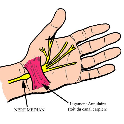 Le syndrome du canal carpien et les solutions à apporter en ostéopathie